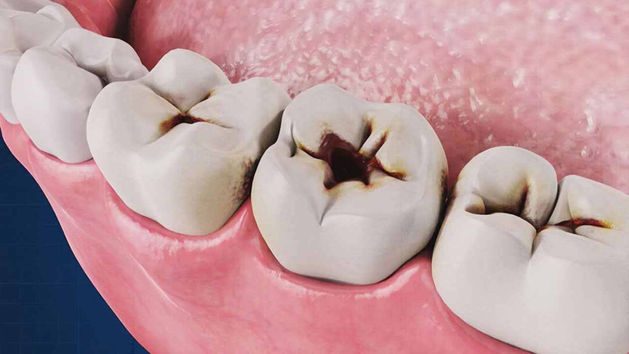 چرا دندان های آسیا دچار پوسیدگی بیشتری می شوند