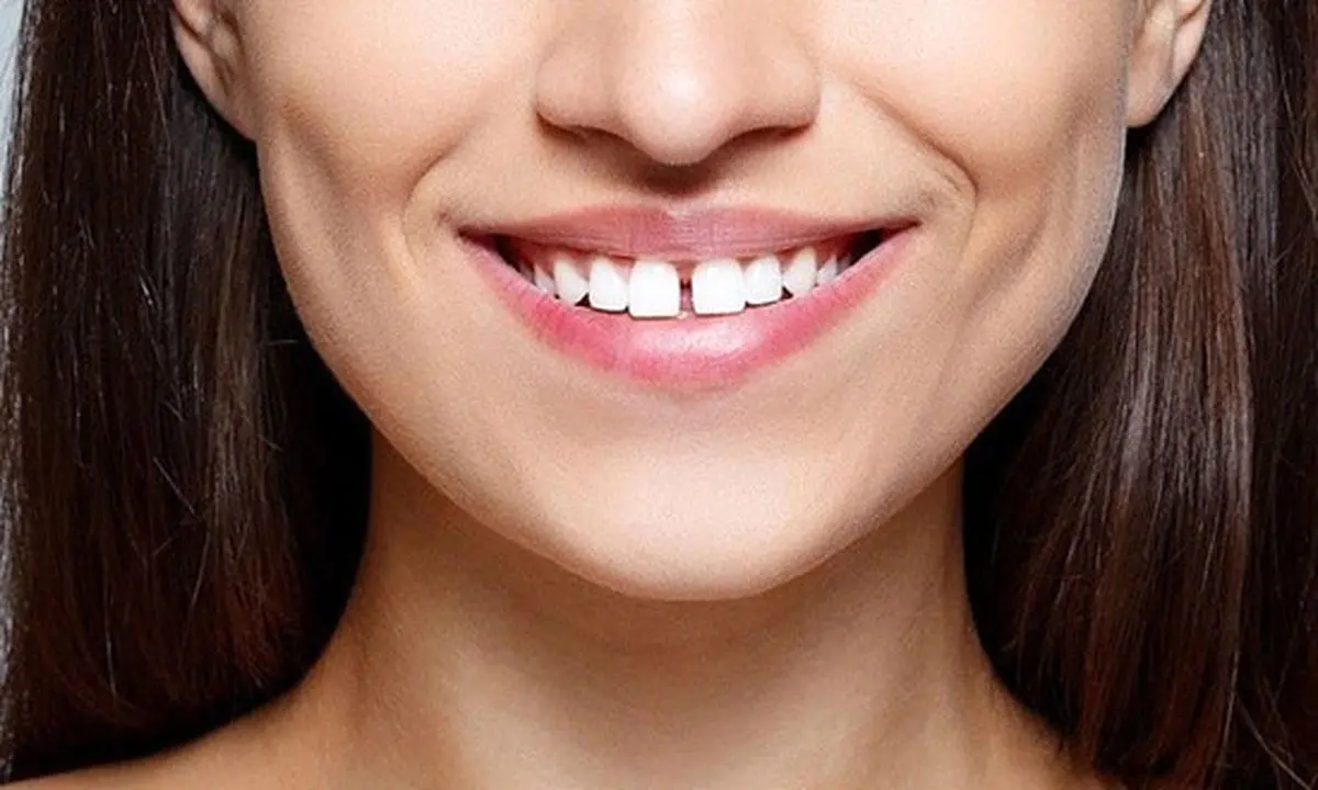 برای دندان های فاصله دار چه باید کرد