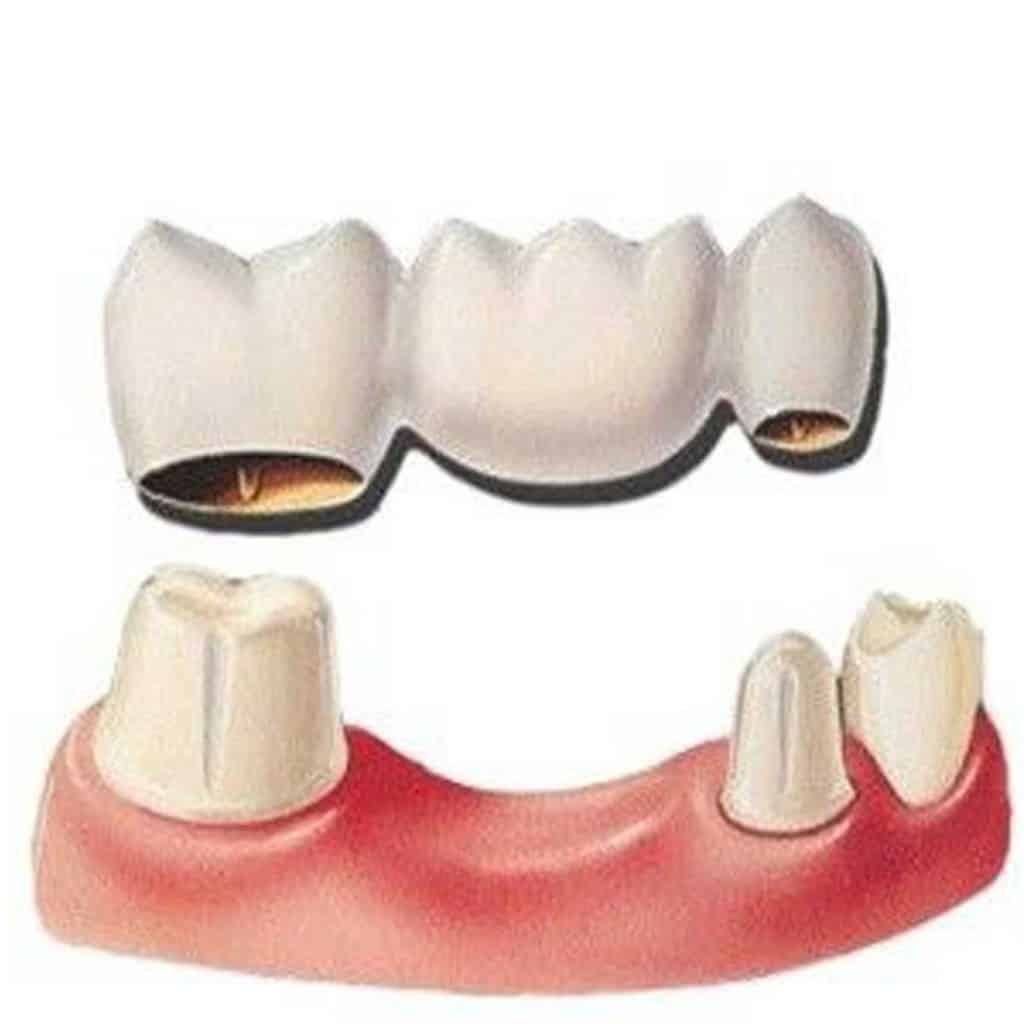 آیا بریج دندان خوب است